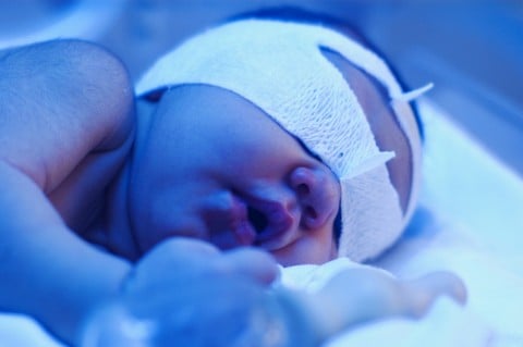 心配なママ必見 新生児の黄疸は病気 気になる疑問を解説